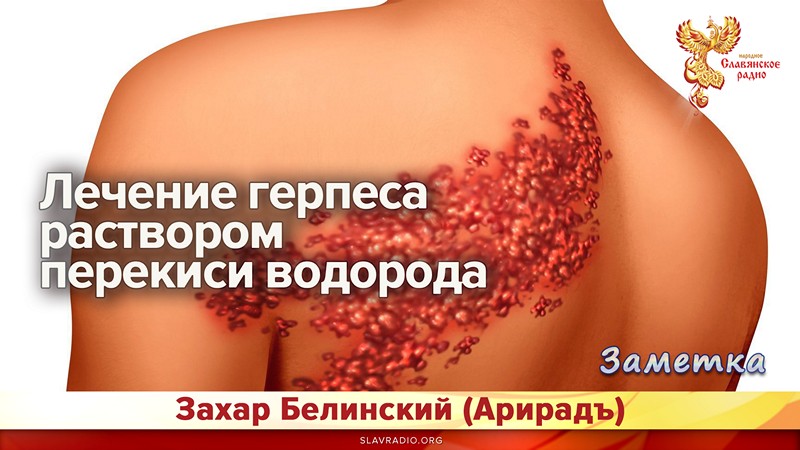 Лечение герпеса раствором перекиси водорода
